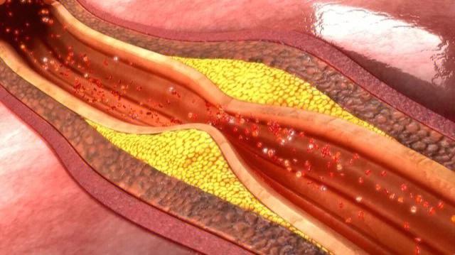怎样降低胆固醇清理血管