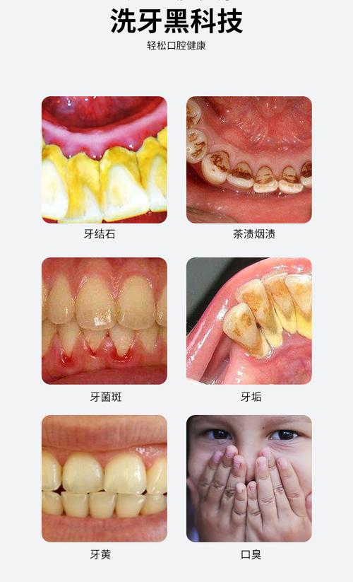 牙结石是怎么形成的需要洗牙吗